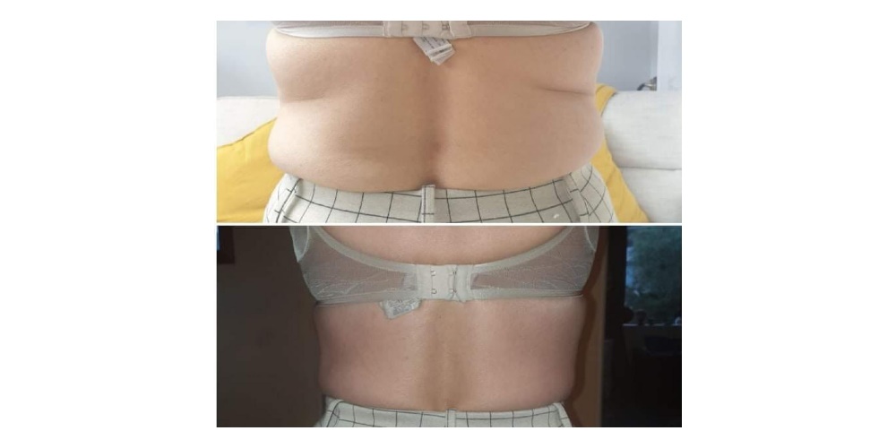 Be Lifted Body CoolSculpting